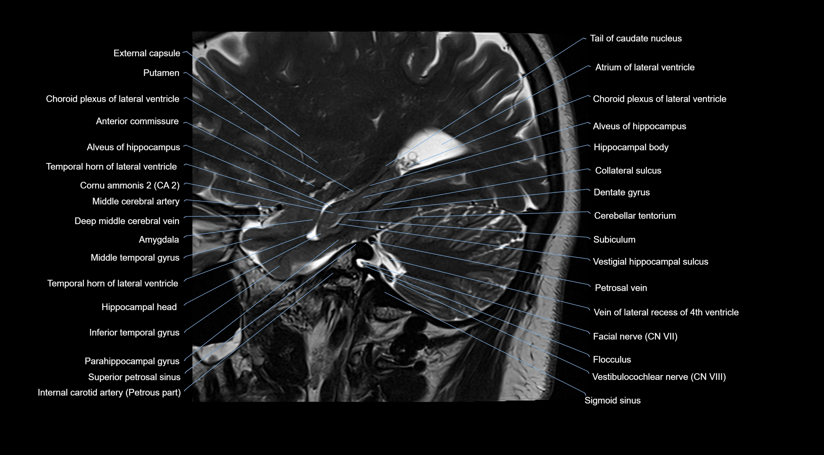 MRI brainstem & basal ganglia anatomy labelled  3T MRI images -img-10001-00012.webp